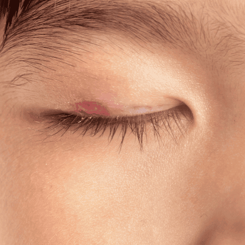 infected eyelid treatment