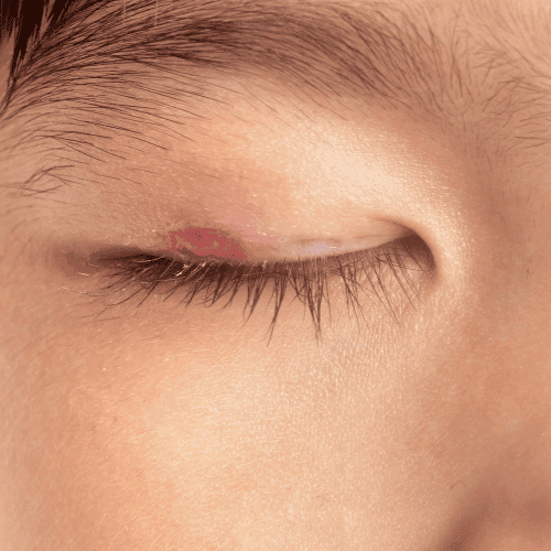 infected eyelid treatment infected eyelid treatment