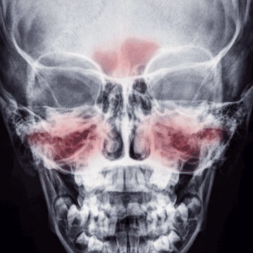 chronic sinusitis icd 10