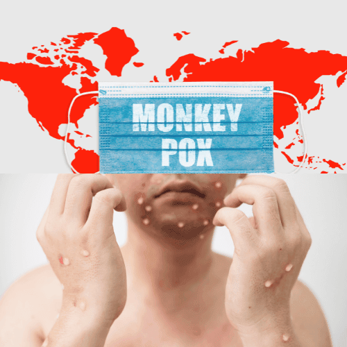 monkey pox in infants