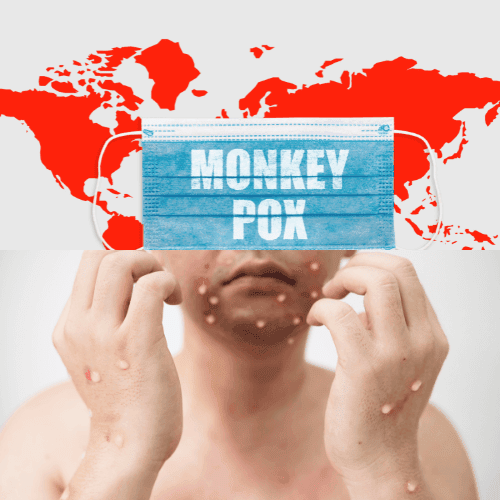 monkey pox in infants monkey pox in infants
