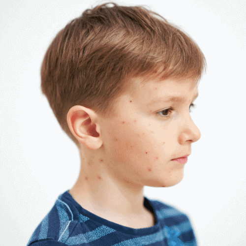 symptoms of small pox in babies symptoms of small pox in babies