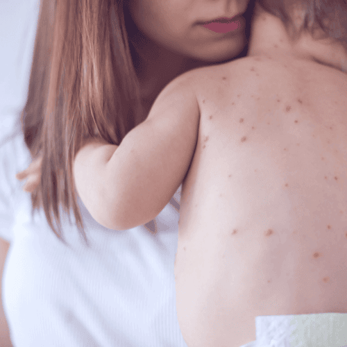 symptoms of small pox