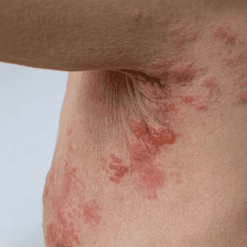shingles in infants shingles in infants